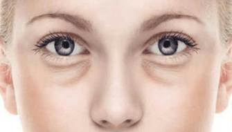 8 Home Remedies You Should Try to Get Rid of Puffy Eye Bags Naturally
